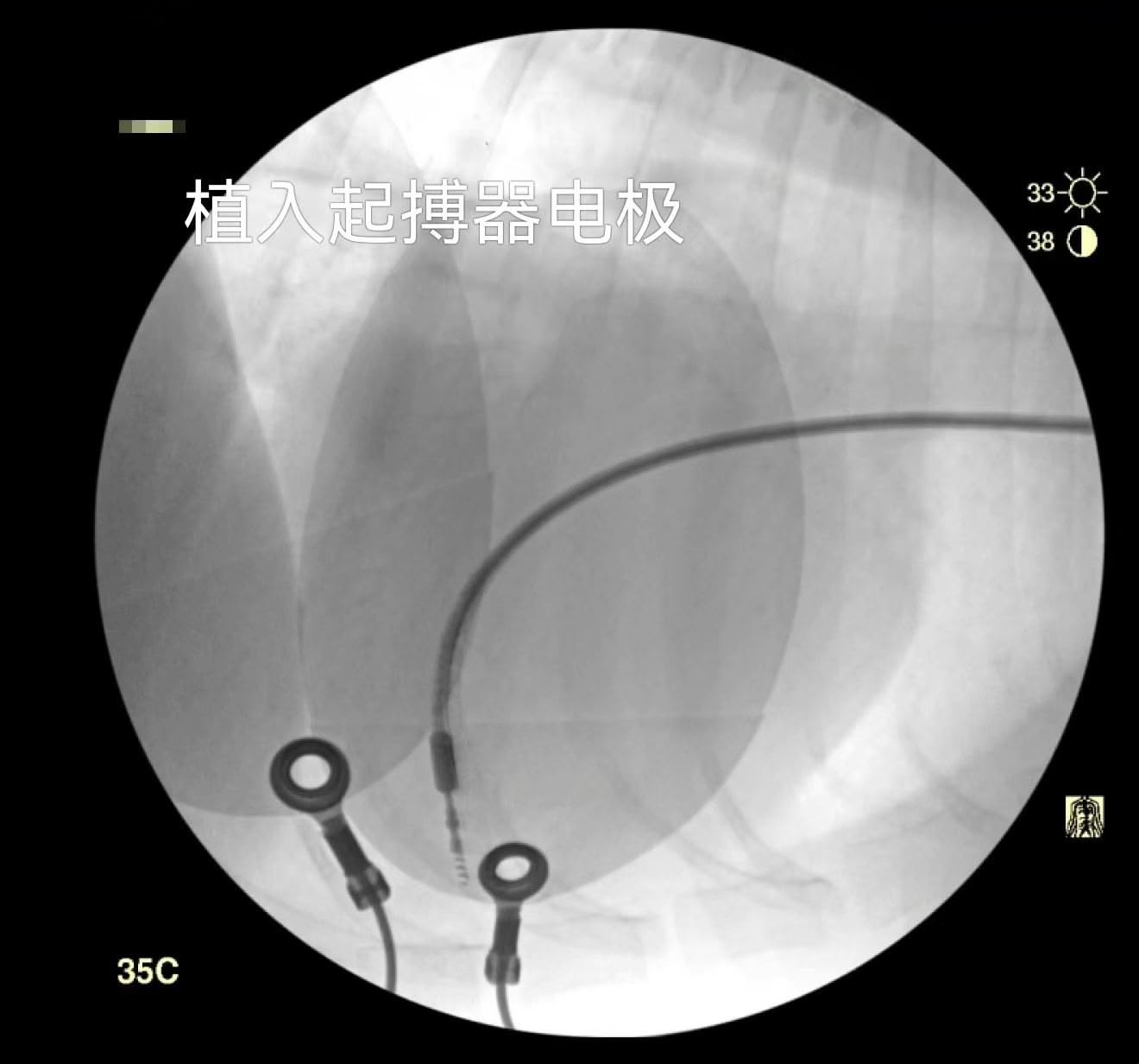Fluoroscopic guidance during pacemaker electrode implantation in a dog